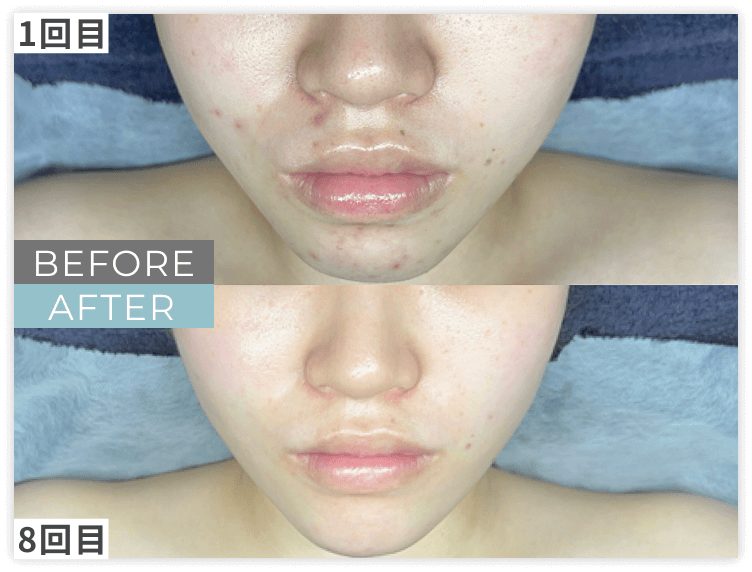 ララピール×LDMのビフォー/アフター